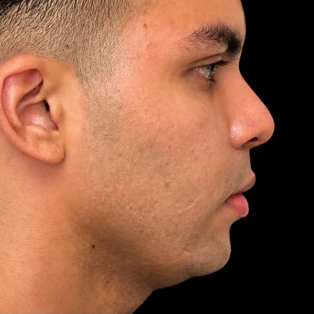 Contorno mandibular antes do tratamento
