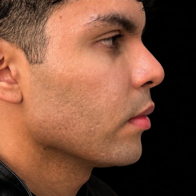 Contorno mandibular após o tratamento