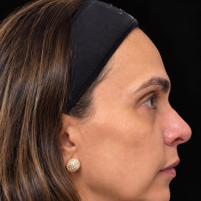 Vista de perfil antes do tratamento